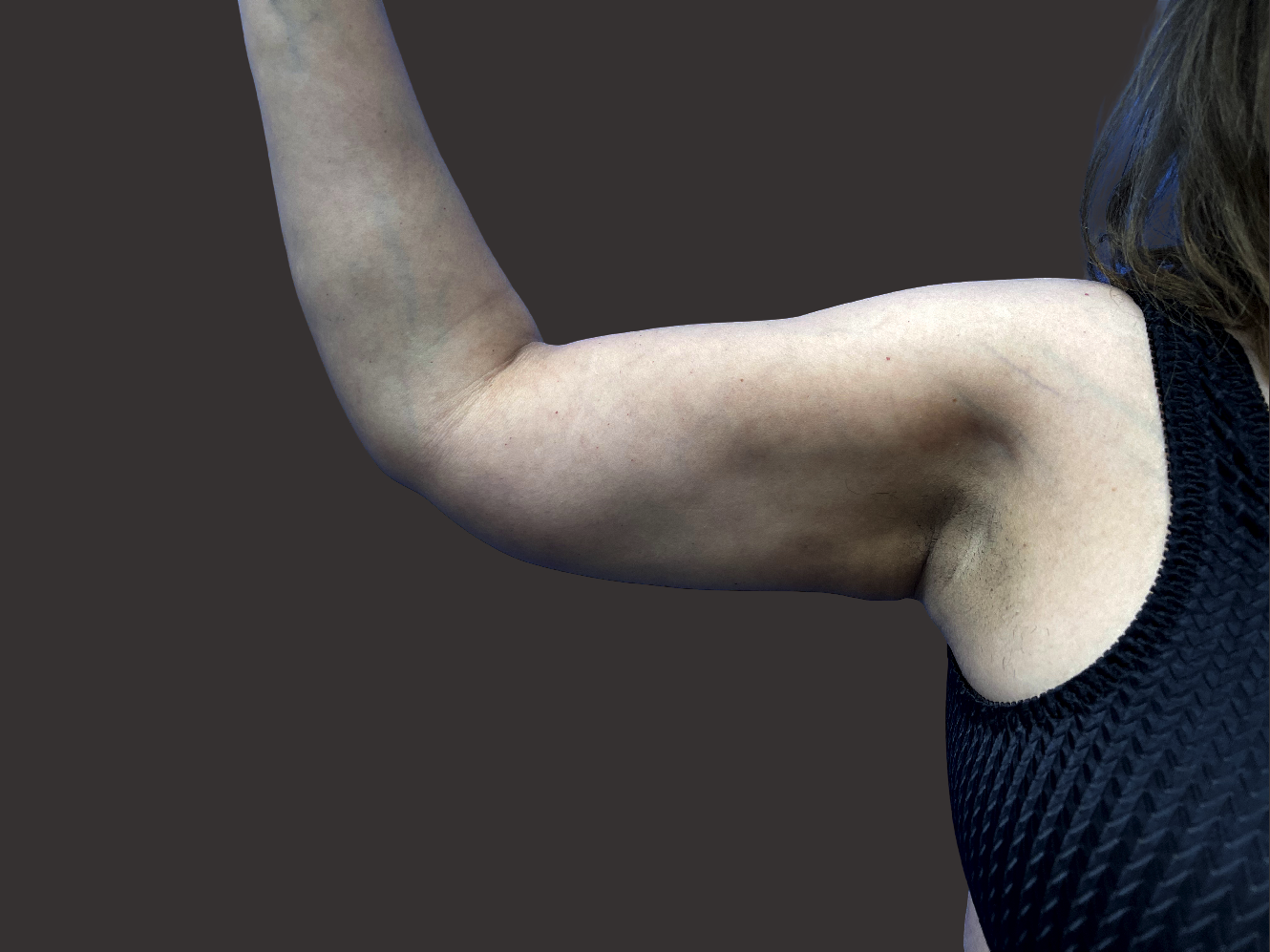 Case--2107-Arm-Tuck | After Body