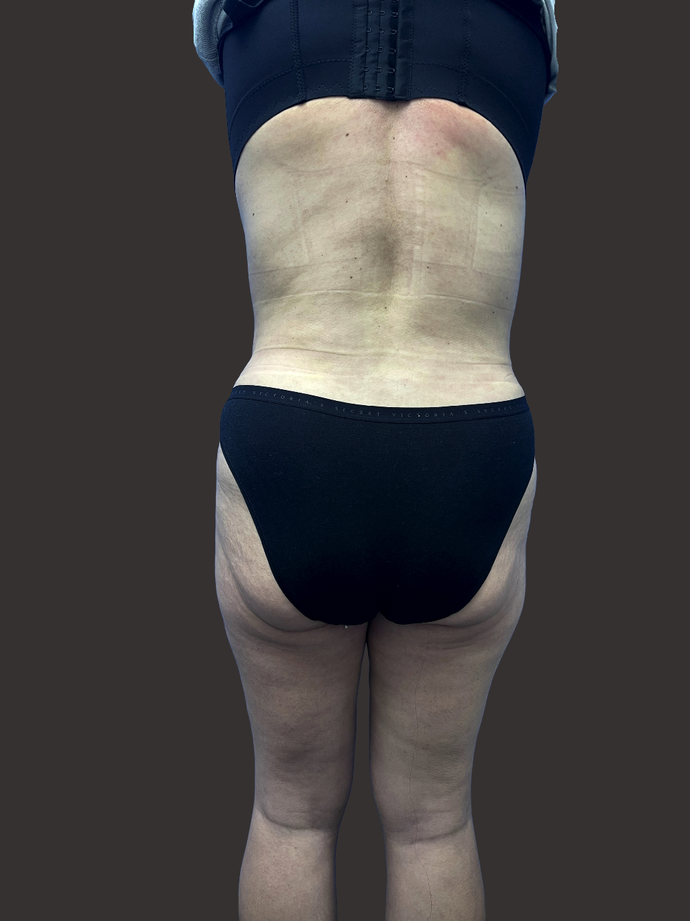 Case--8320-Liposuction | After Liposuction