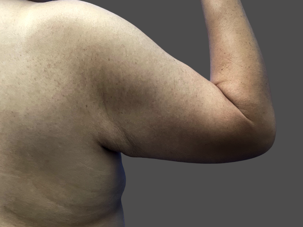 Case--7269-Arm-Tuck | Before Body