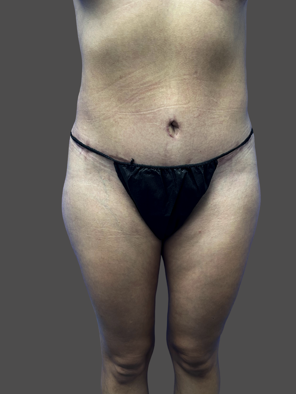 Case--7277-Tummy-Tuck | After Tummy Tuck