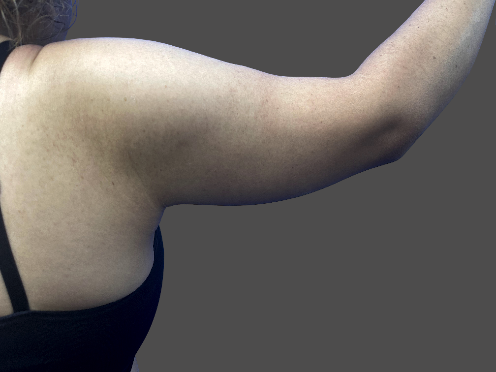 Case--7269-Arm-Tuck | After Body