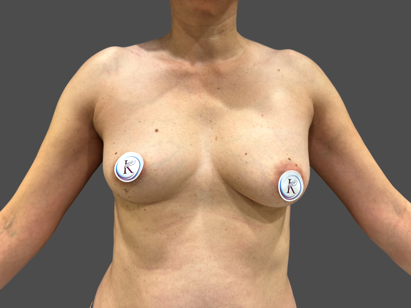 Case--4714-Breast-Augmentation | Before Breast Augmentation