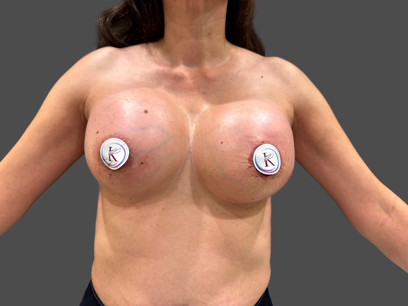 Case--4714-Breast-Augmentation | After Breast Augmentation