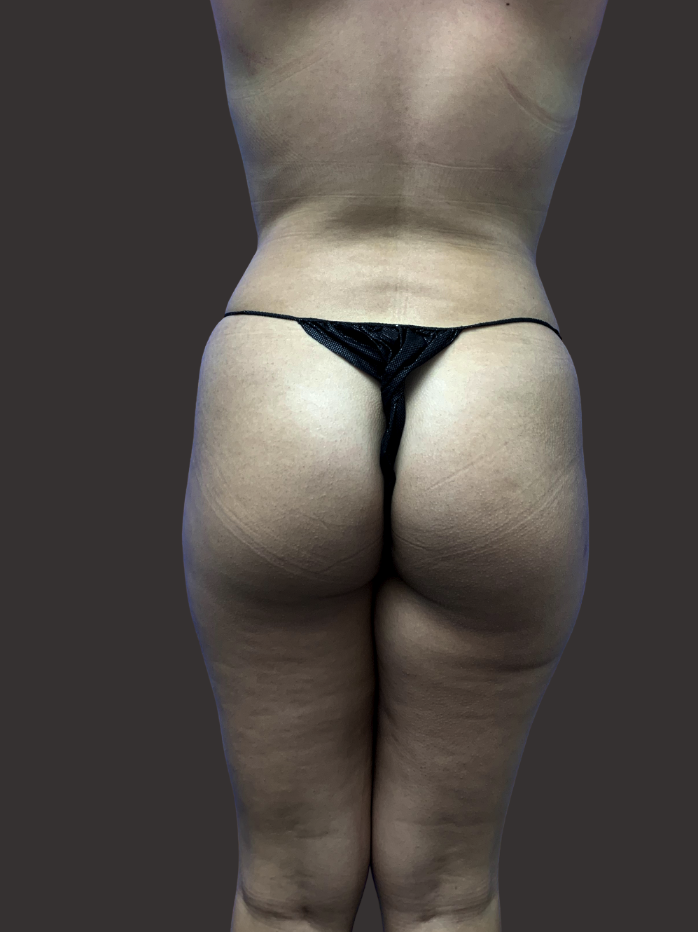 Case--8490-Liposuction | After Body