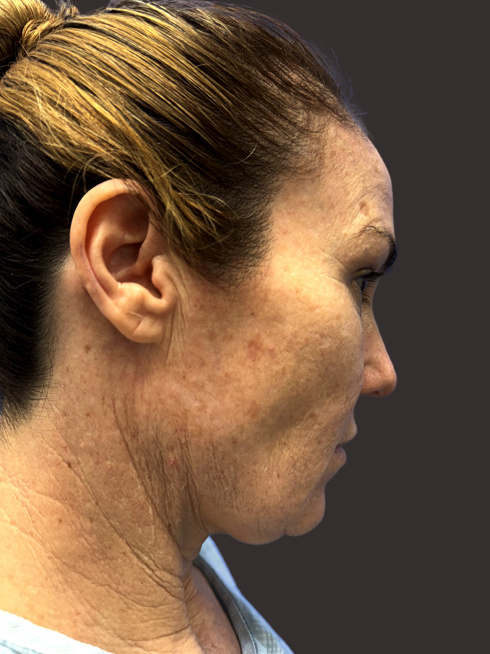 Before Facelift Gallery - Bruce Kadz Beverly Hills Plastic Surgery