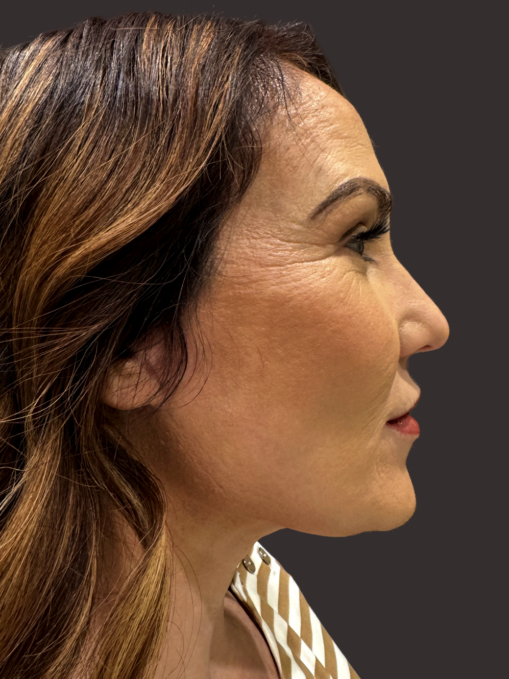 After Facelift Gallery - Bruce Kadz Beverly Hills Plastic Surgery