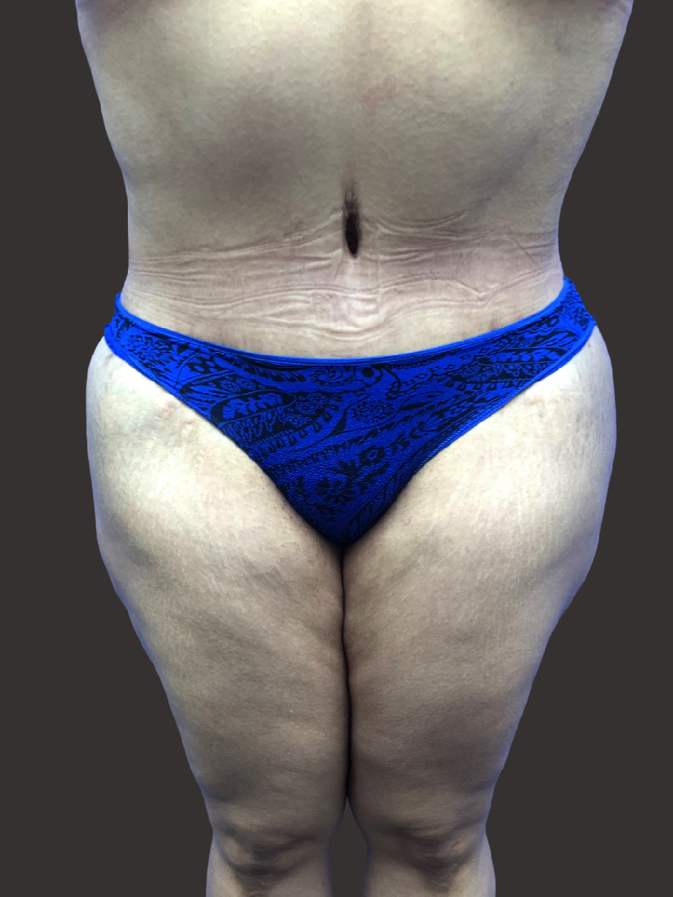 Case--2722-Tummy-Tuck | After Tummy Tuck