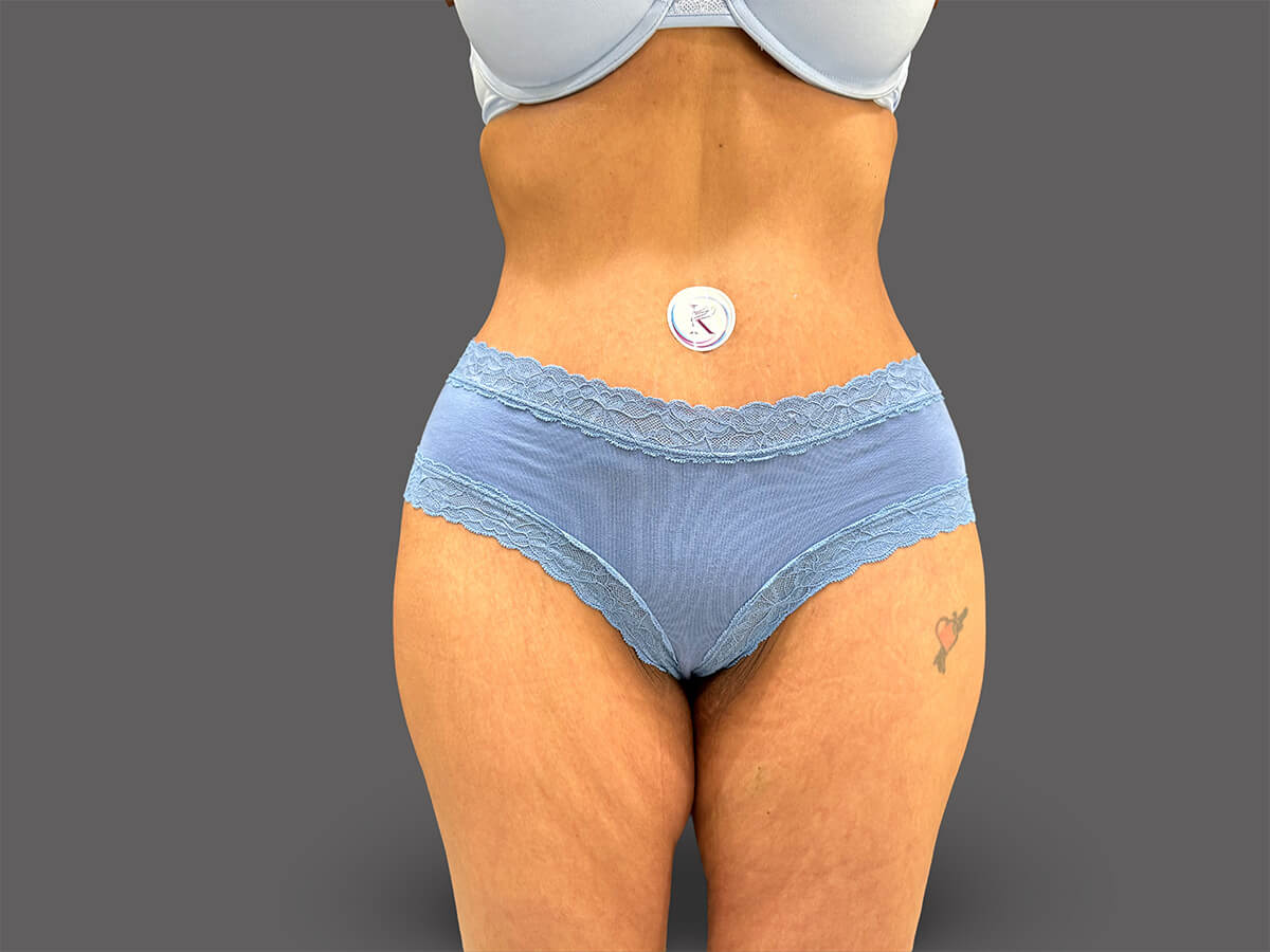 Case--7689-Tummy-Tuck | After Body