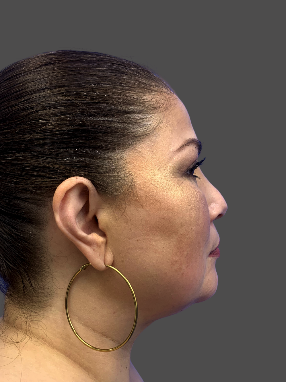 Case--7874-Neck-Liposuction | After Neck Liposuction