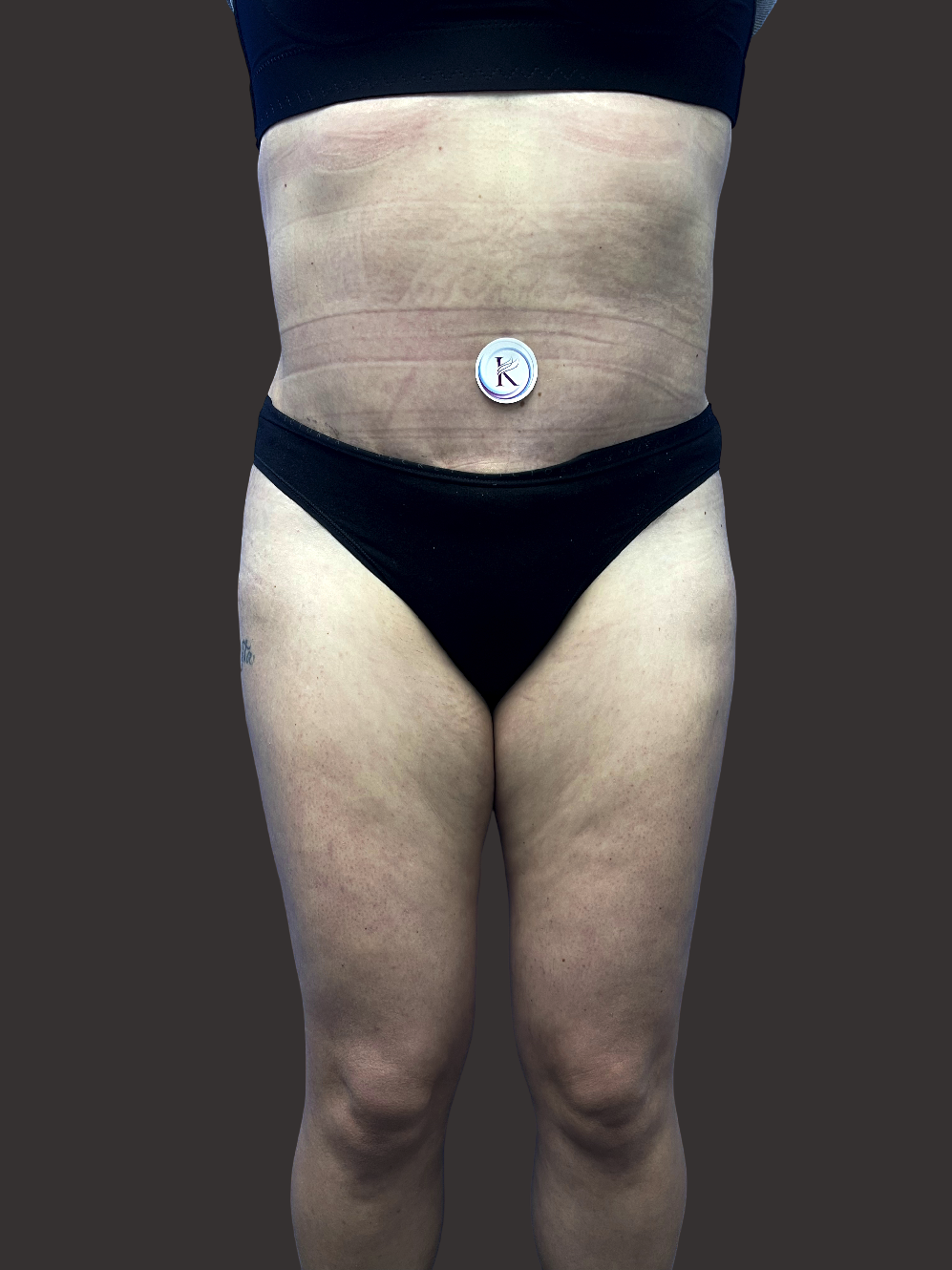 Case--2496-Tummy-Tuck | After Tummy Tuck