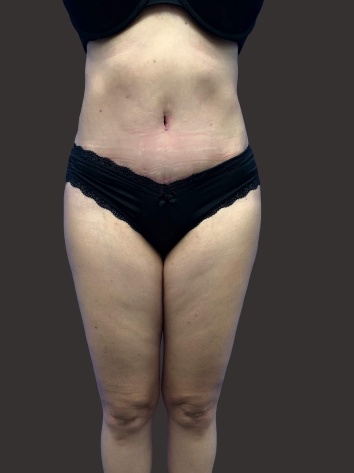 Case--7227-Tummy-Tuck | After Tummy Tuck