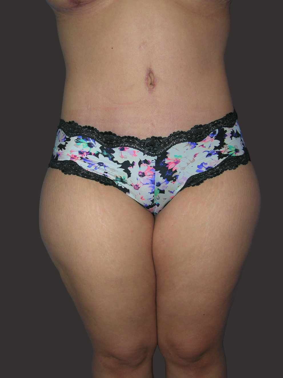 Case--8396-Tummy-Tuck | After Tummy Tuck