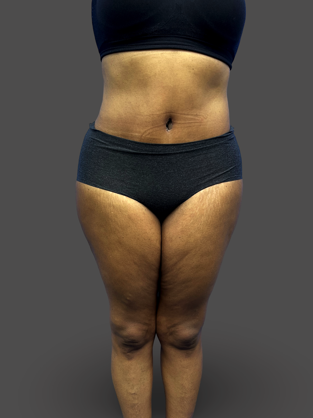 Case--4114-Tummy-Tuck | After Tummy Tuck