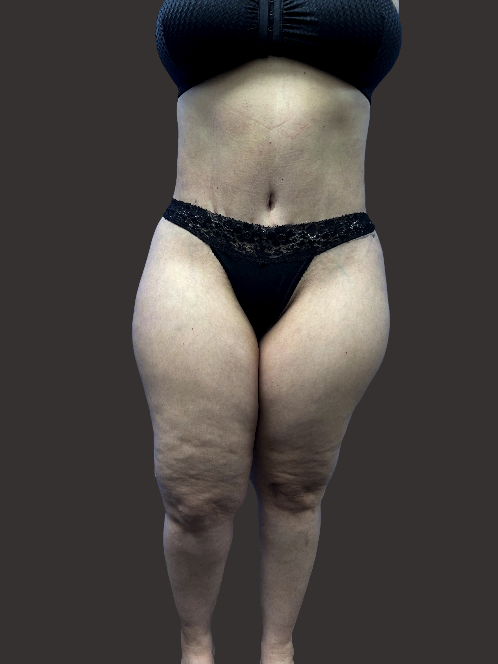 Case--1687-Tummy-Tuck | After Tummy Tuck