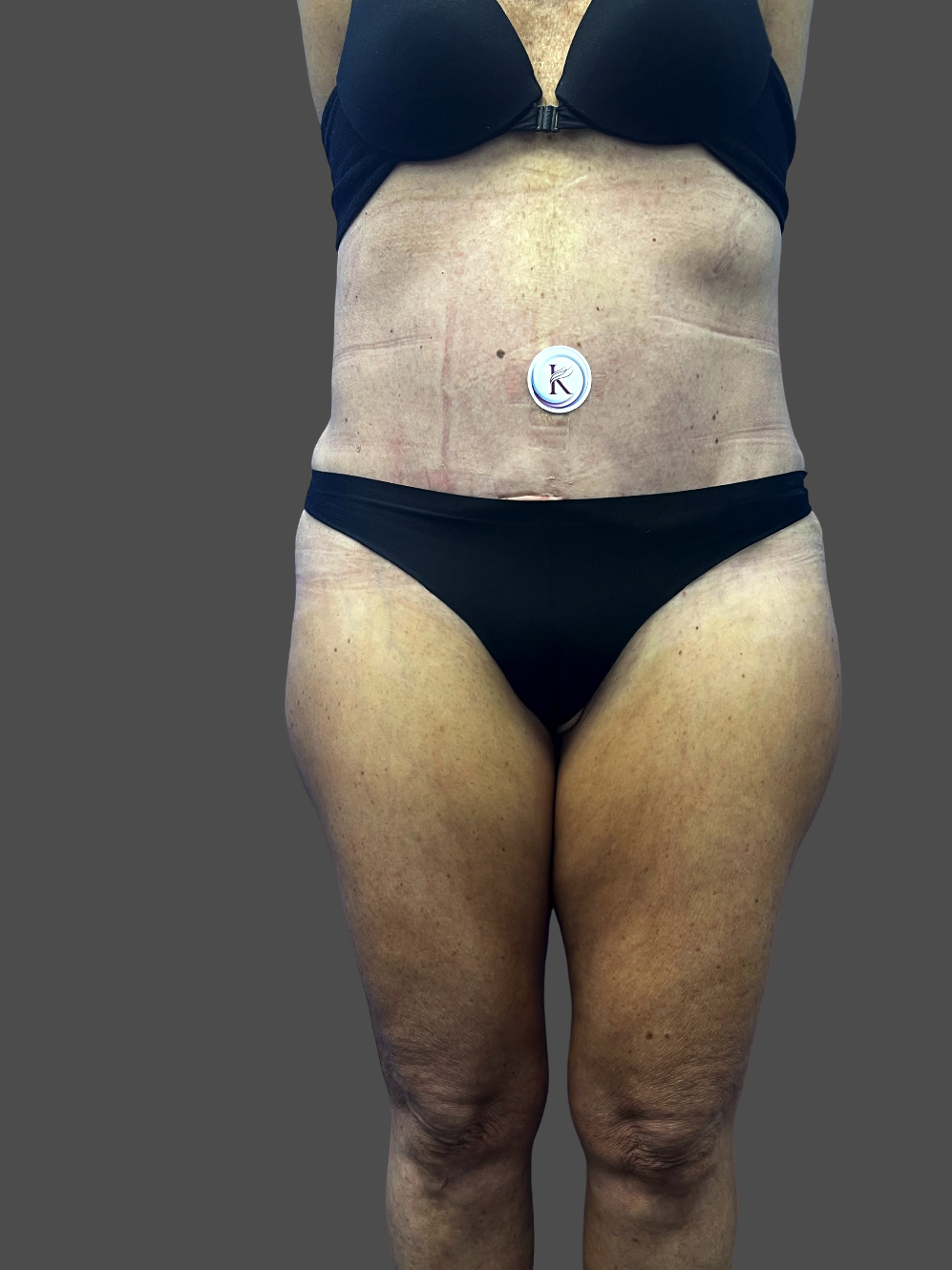 Case--3926-Tummy-Tuck | After Tummy Tuck