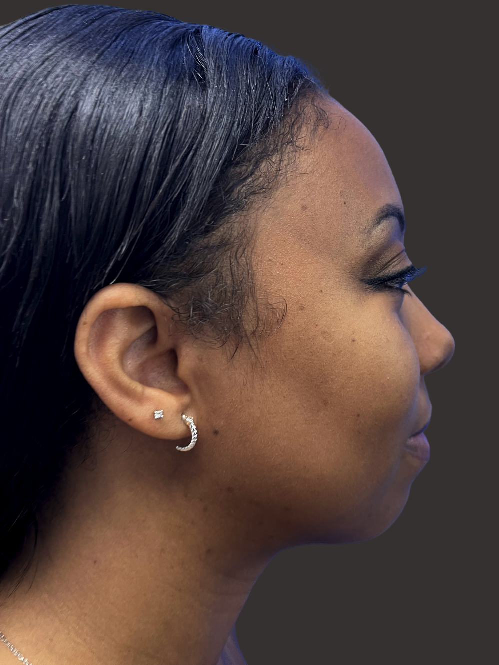 Case--6669-Neck-Liposuction | After Neck Liposuction