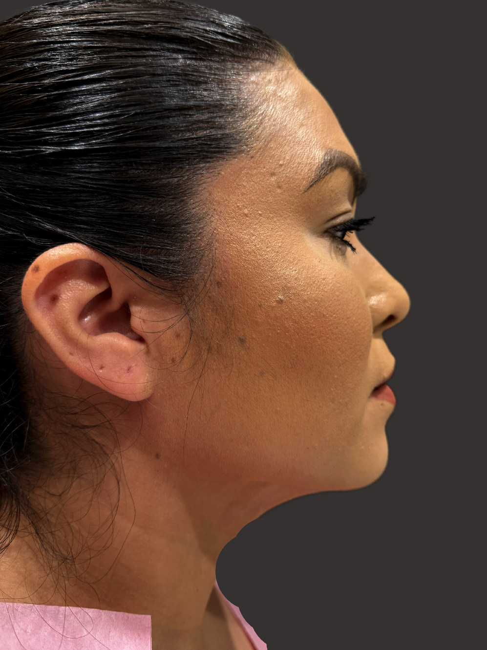 Case--9087-Neck-Liposuction | After Neck Liposuction