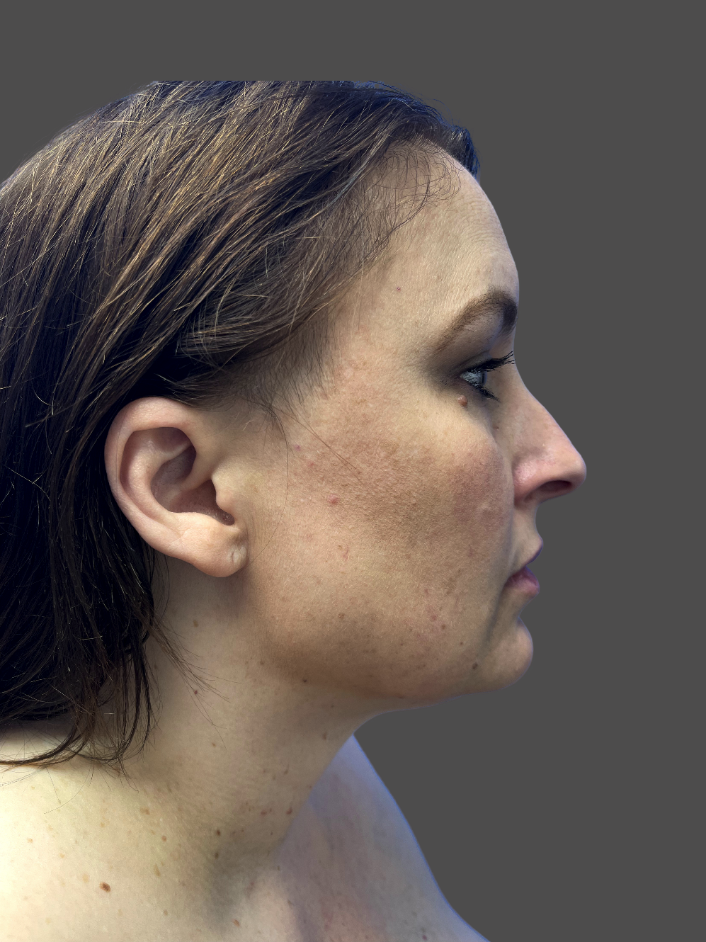 Case--5193-Neck-Liposuction | After Neck Liposuction