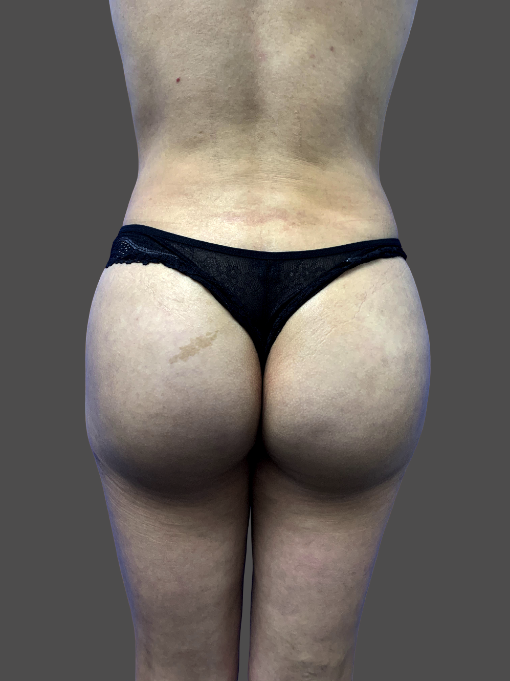 Case--4049-Brazilian-Butt-Lift | After Body