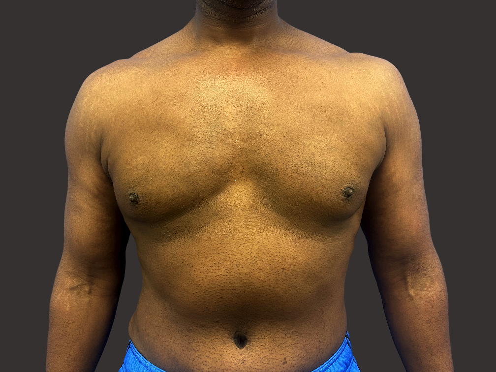 Case--7586-Male-Surgery | After Male Surgery