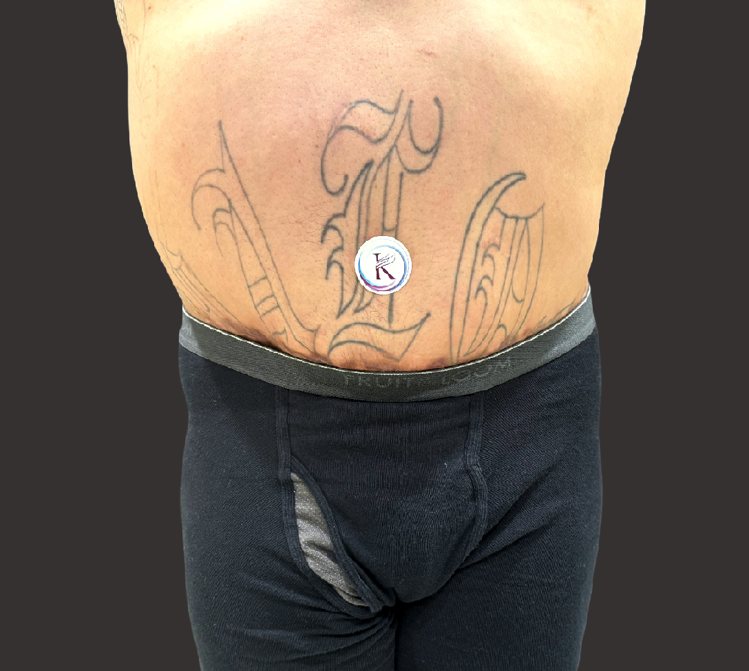 Case--9340-Male-Surgery | After Male Surgery