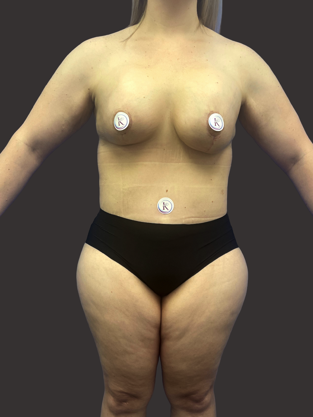 Case--5418-Breast-Lift | After Breast Lift