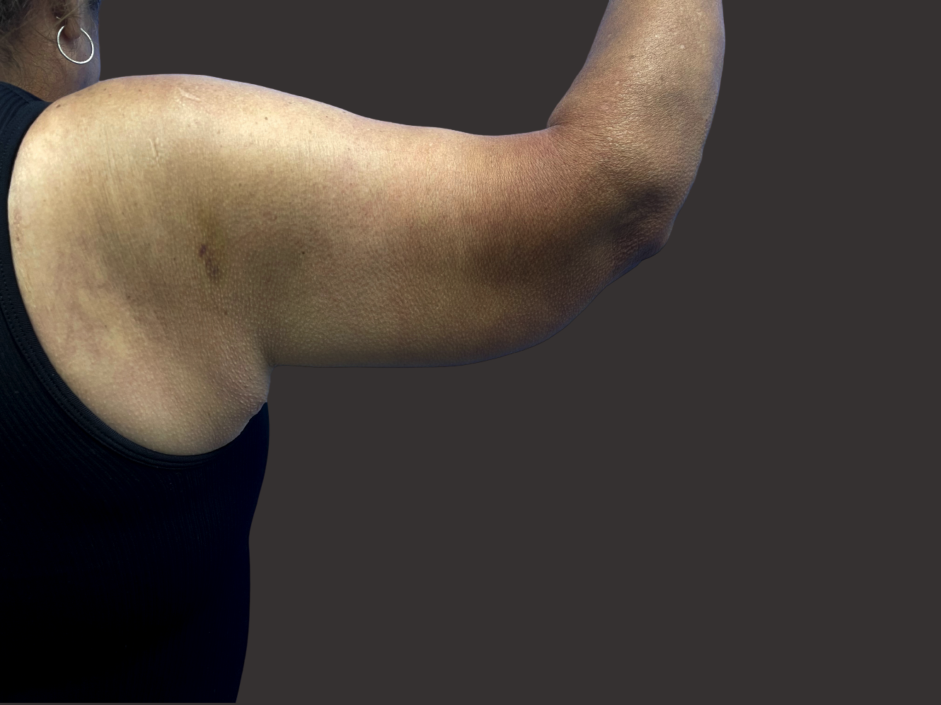 Case--1630-Arm-Tuck | After Body