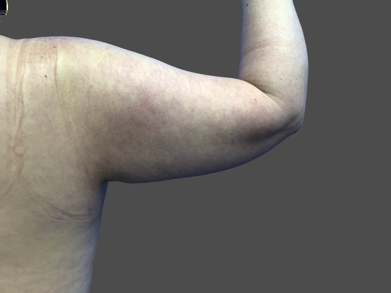 Case--4301-Arm-Tuck | After Body