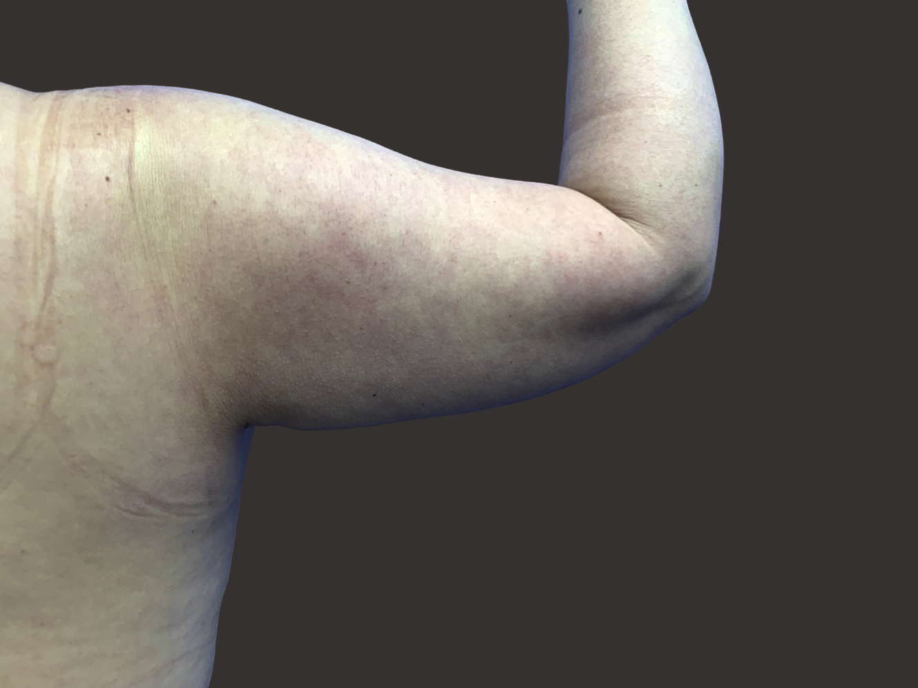 Case--7430-Arm-Tuck | After Body