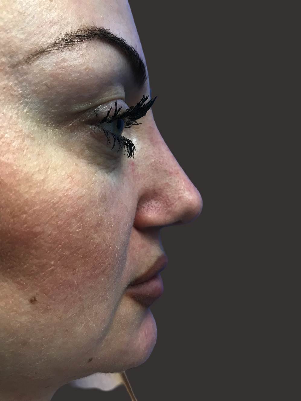 Case--3927-Rhinoplasty | After Rhinoplasty