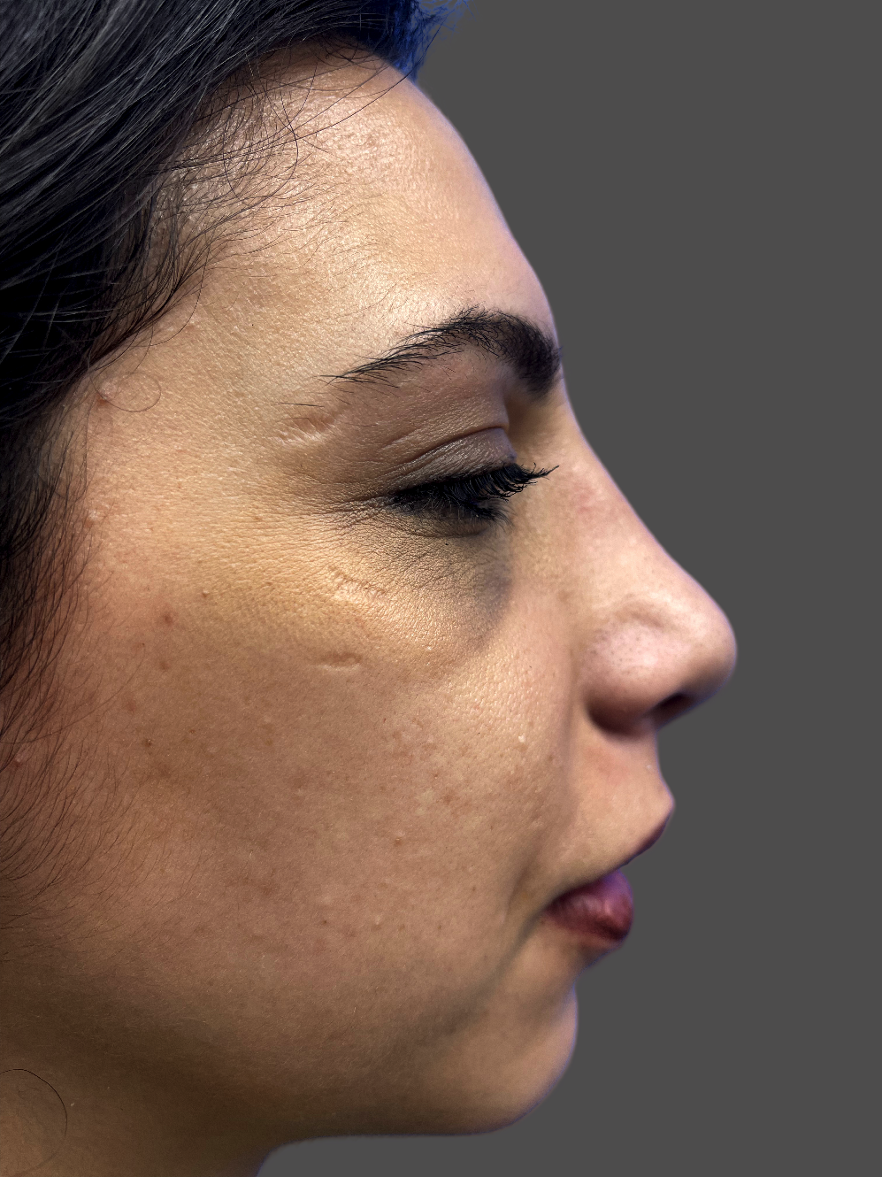 Case--7708-Rhinoplasty | After Rhinoplasty