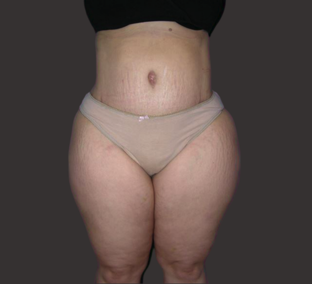 Case--7203-Post-Massive-Weight-Loss-Surgery | After Body