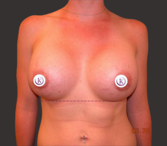 Case--9589-Breast-Augmentation | After Breast Augmentation