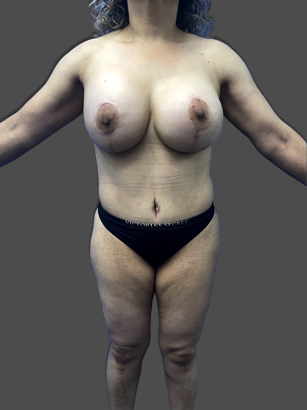 Case--3754-Mommy-Makeover | After Mommy Makeover