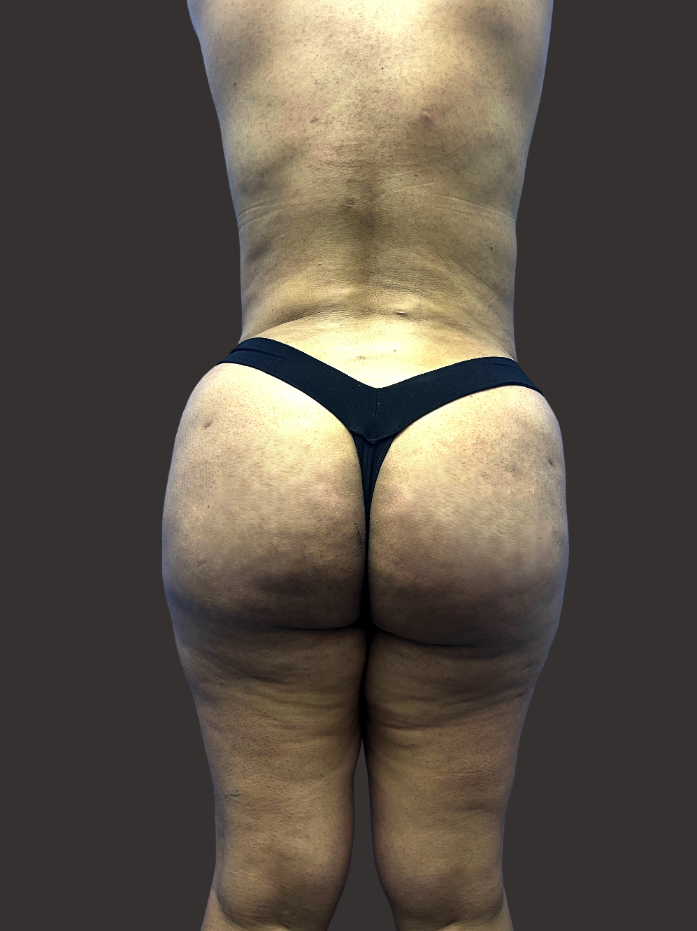 Case--9252-Liposuction | After Liposuction