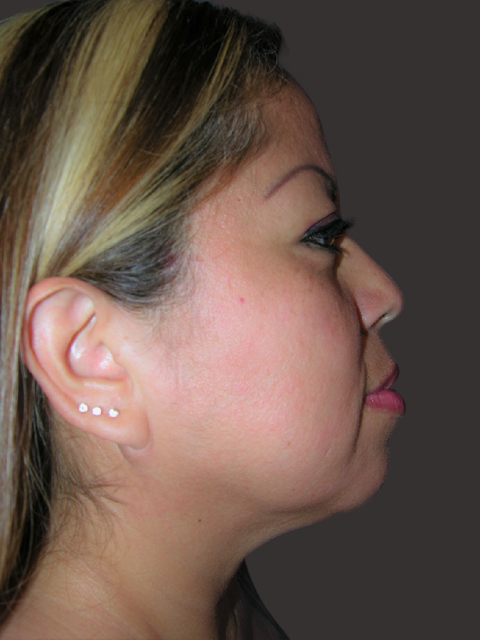 Case--5934-Neck-Liposuction | After Neck Liposuction
