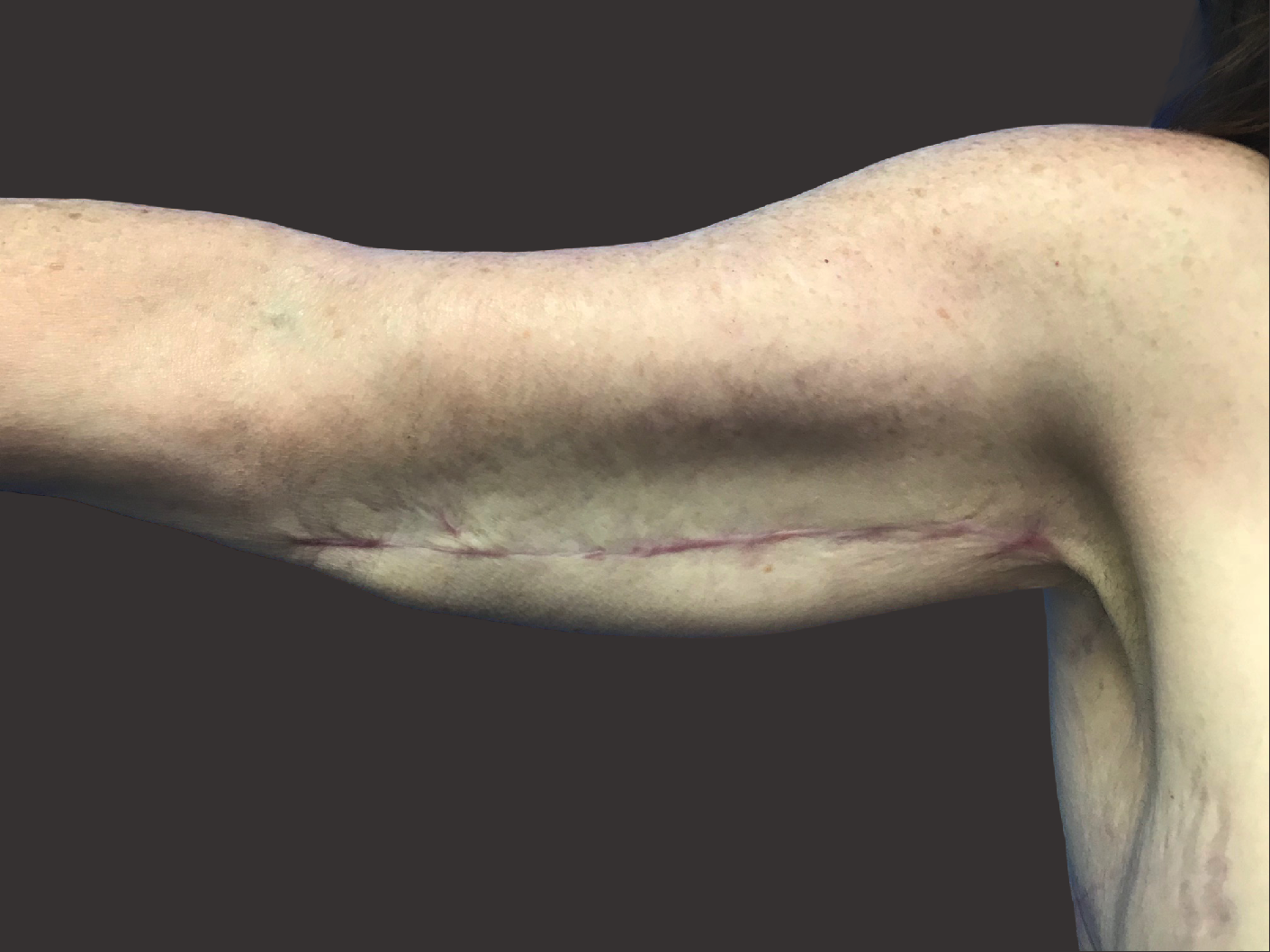 Case--1423-Arm-Tuck | After Body