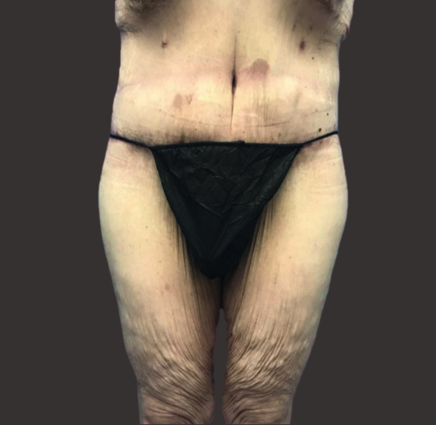 Case--2947-Male-Surgery | After Male Surgery