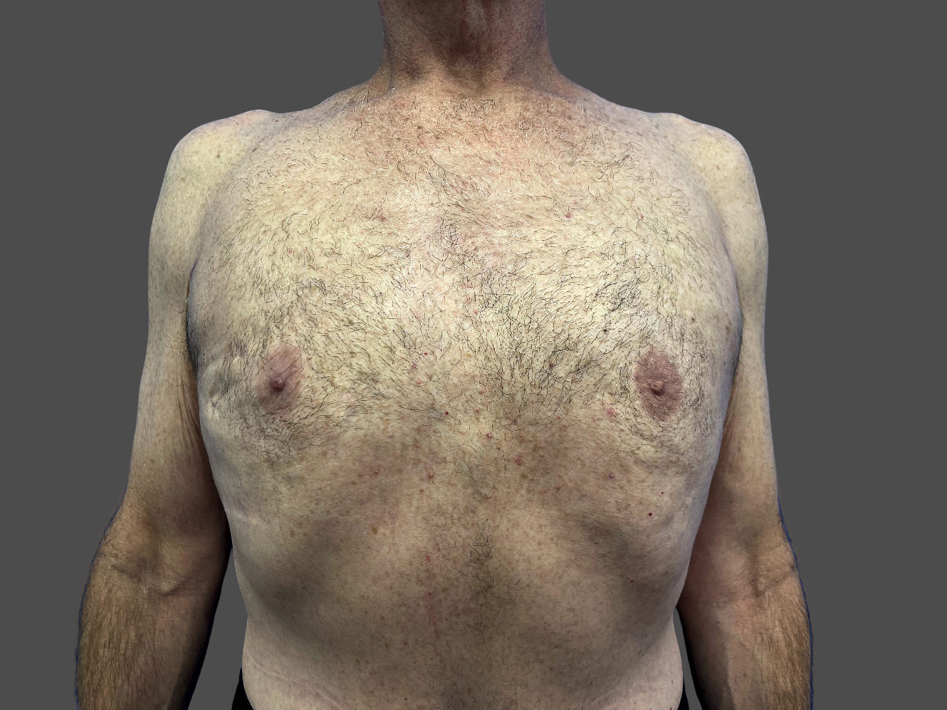 Case--9537-Male-Surgery | After Male Surgery