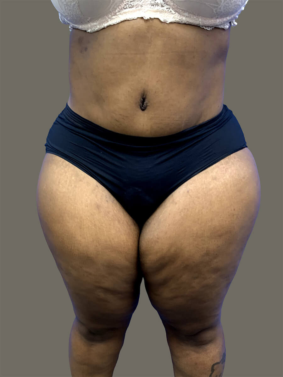 Case--1934-Tummy-Tuck | After Body