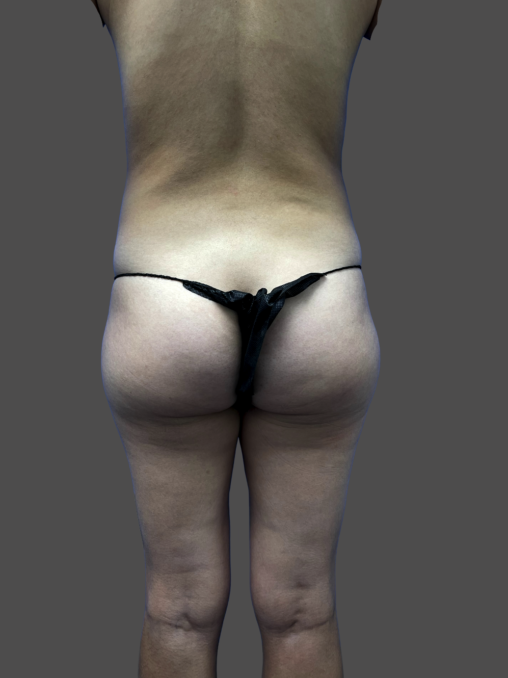 Case--2475-Liposuction | Before Body