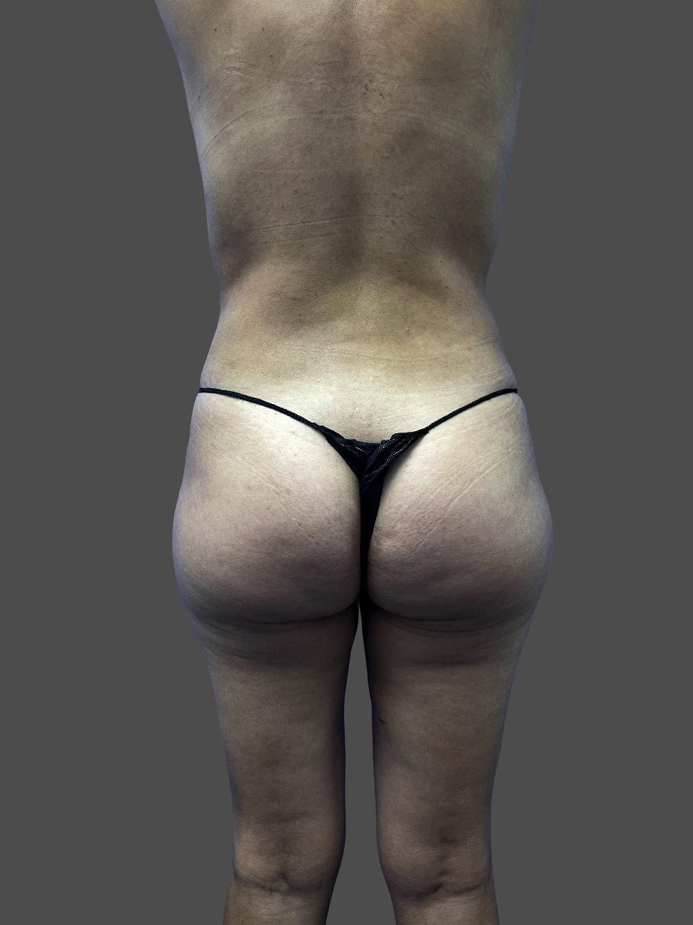 Case--2475-Liposuction | After Body