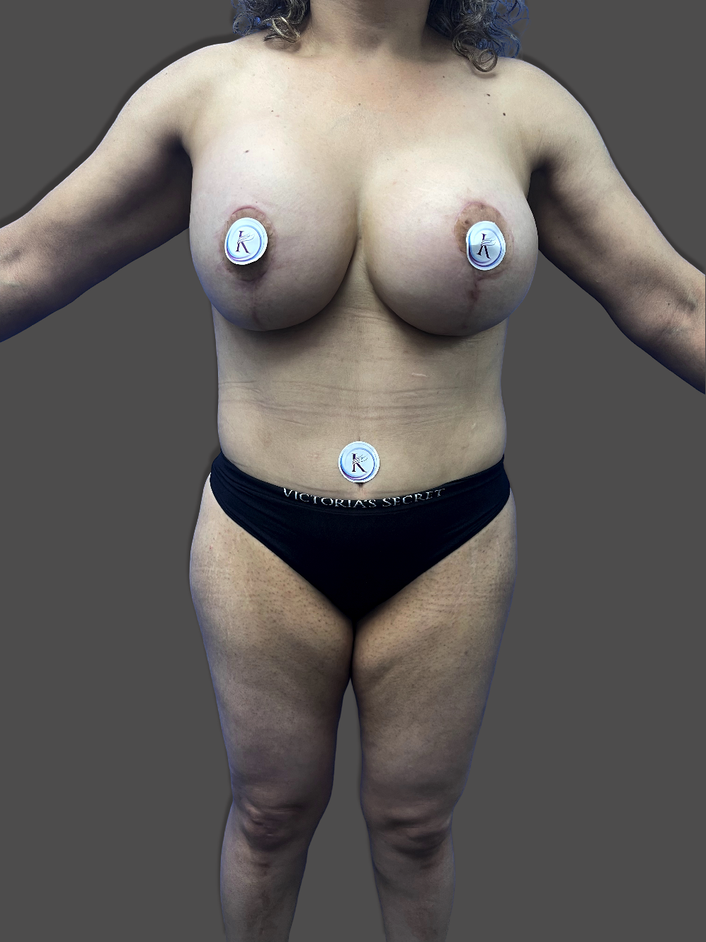 Case--4005-Tummy-Tuck | After Tummy Tuck