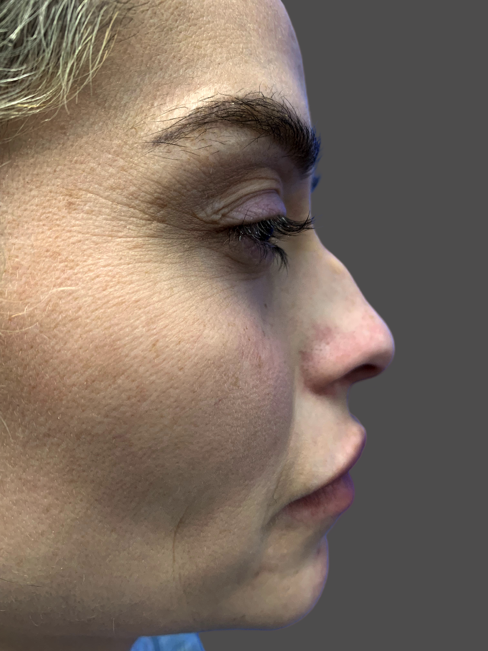 Case--4580-Rhinoplasty | Before Rhinoplasty