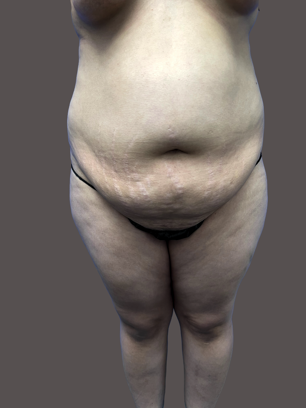 Case--3727-Tummy-Tuck | Before Tummy Tuck