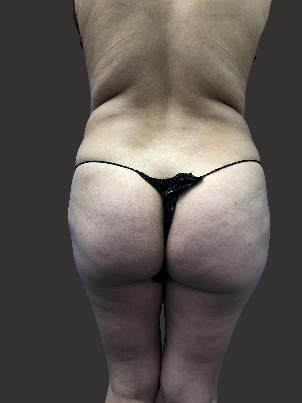 Case--1811-Brazilian-Butt-Lift | Before Body