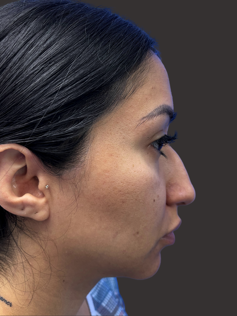 Case--8106-Rhinoplasty | Before Rhinoplasty