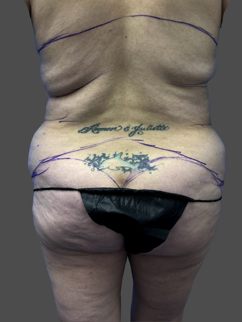 Case--8703-Liposuction | Before Body