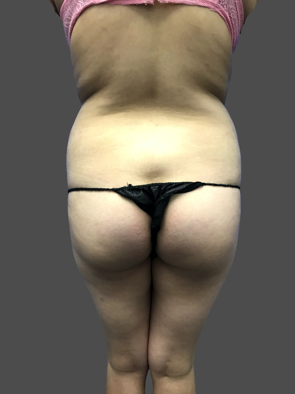 Case--7658-Liposuction | Before Body