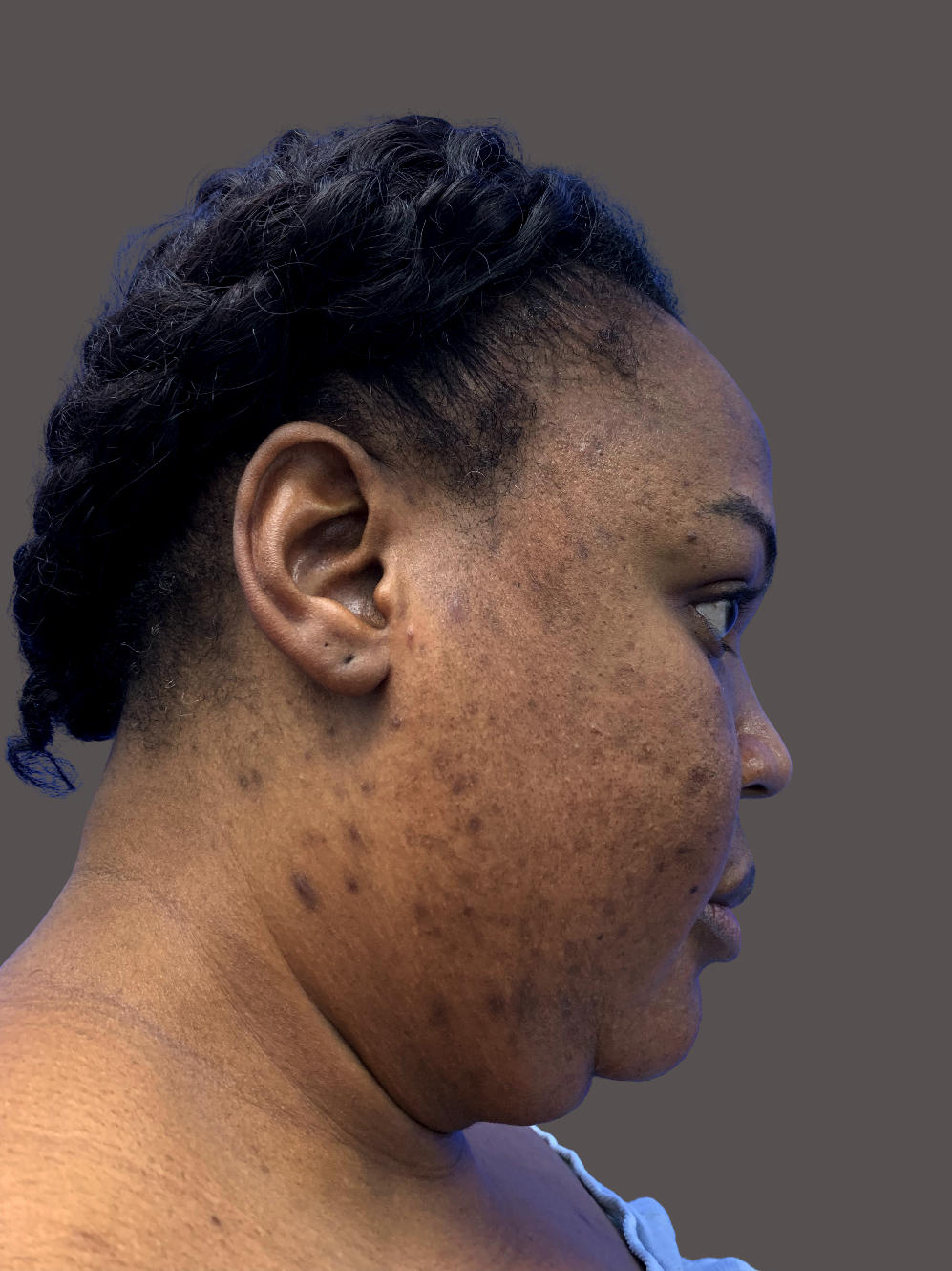 Case--8662-Neck-Liposuction | Before Neck Liposuction